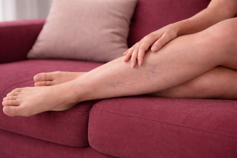 Как ранние симптомы помогают выявить варикоз